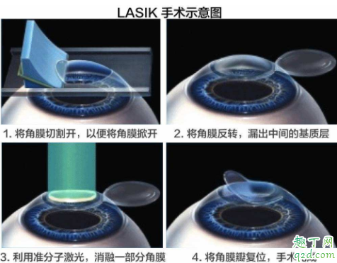 激光近视矫正手术伤眼睛吗 眼睛近视激光会不会有后遗症