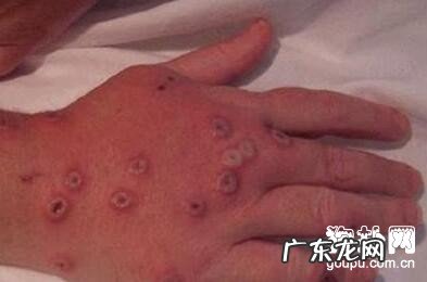 【狂犬病毒早期症状】狂犬病症状及防止方式