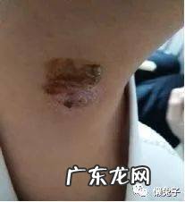 中医治愈深度囊肿医案分享