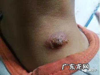 中医治愈深度囊肿医案分享