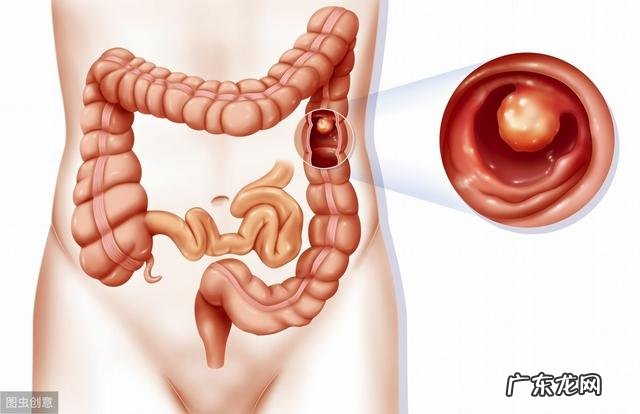 做肠镜前一天三餐早餐白粥中午面条晚上面条可以吗?