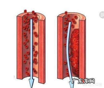 孕期什么情况下需要打肝素?