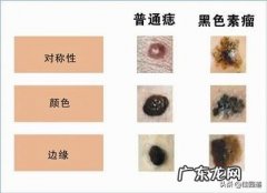 黑色素瘤一般潜伏期多久有何症状