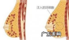 自体脂肪填充胸部能维持多久