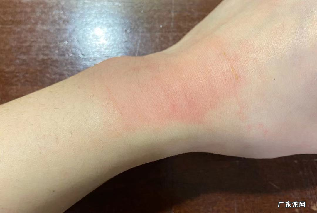 贴膏药步骤和注意事项 虎牌膏药怎么贴