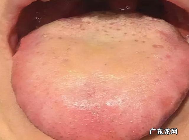 花椒治失眠最快 治疗失眠的十大偏方