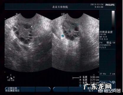 多囊卵巢成功怀孕的几率大吗