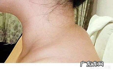 人肩膀上的富贵包要怎样才能消除