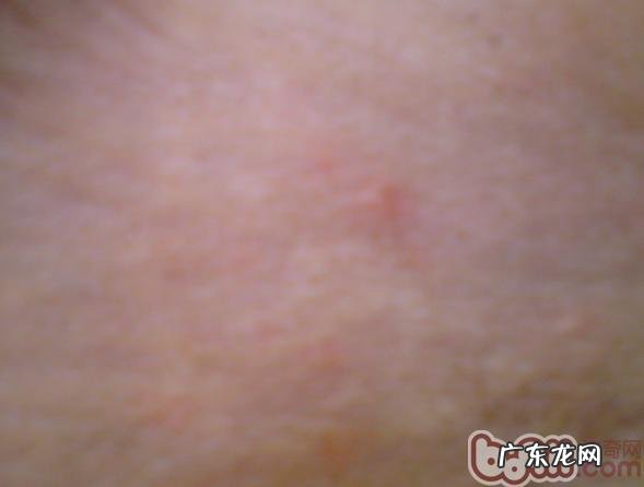 夏天皮肤疾病多发性的缘故和防范措施