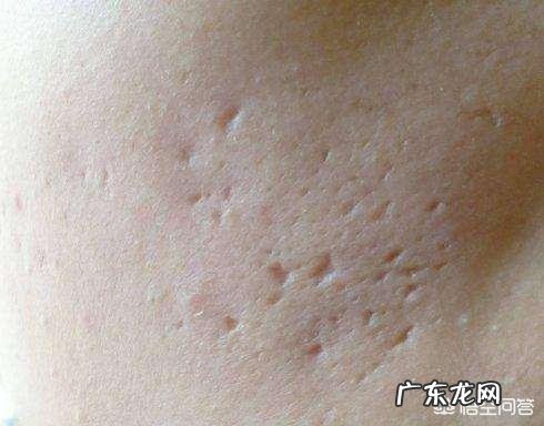 怎么消除脸上痘痘和挤完痘痘留下的斑