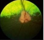 有关小狗闭角型青光眼的医治实例