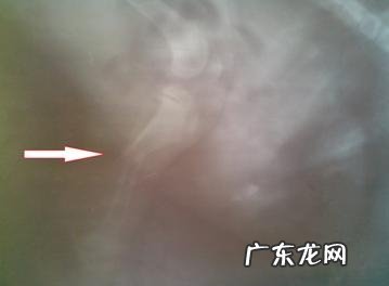 一例有关骨裂后医治耽误的实例