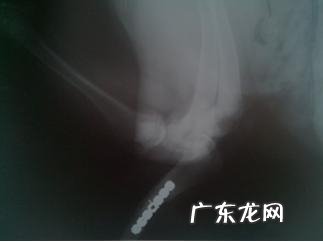 一例有关骨裂后医治耽误的实例