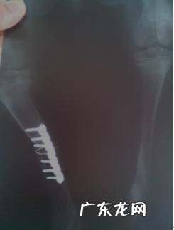 一例有关骨裂后医治耽误的实例