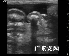 犬扩张型肥厚性心肌病