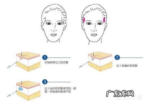 明知道打玻尿酸脸会有后遗症,为什么大批女星前赴后继的想不开