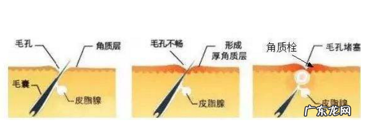 去角质的小窍门简单有效 面部去角质有必要吗