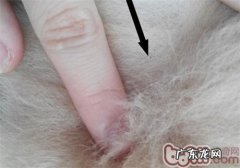 夏天裂头蚴之——虱子