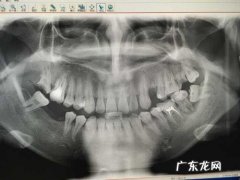 乳牙是满口换吗 27岁满口乳牙