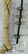 外支撑架在四肢骨骨裂中的运用