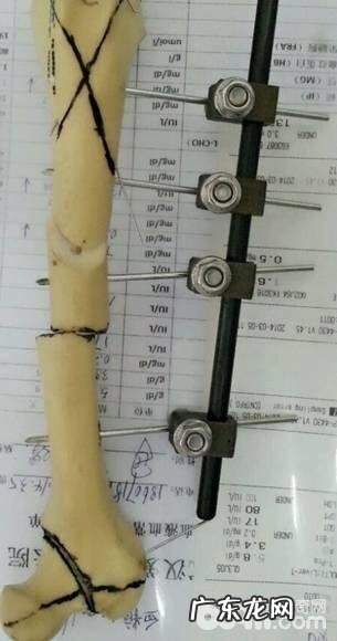 外支撑架在四肢骨骨裂中的运用