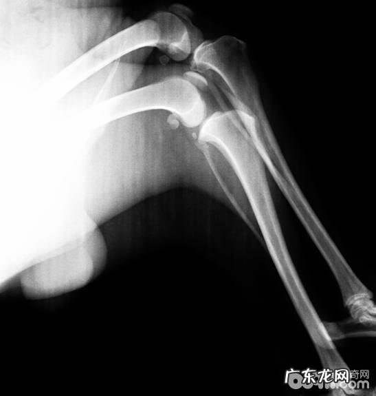 外支撑架在四肢骨骨裂中的运用