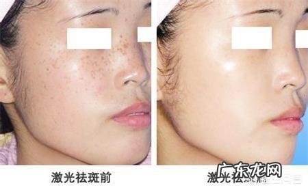 如何祛除老年斑和黄褐斑?