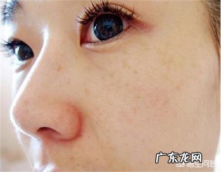 如何祛除老年斑和黄褐斑?