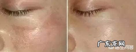 如何祛除老年斑和黄褐斑?