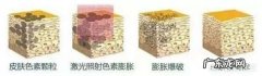 如何祛除老年斑和黄褐斑？