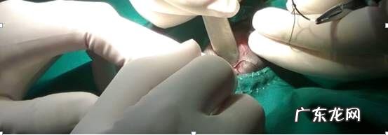 一例创伤造成的目光滑脱