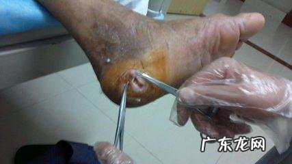 血糖高就一定是糖尿病吗?