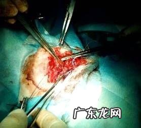 一例犬咬到病例分析