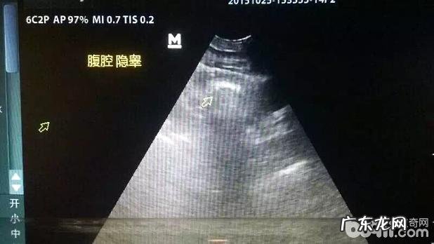 一例金毛隐睾症的病例分析