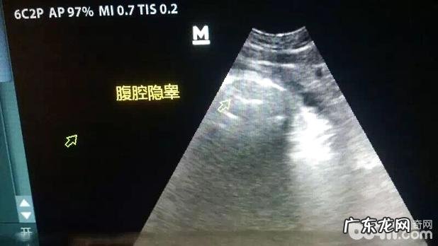 一例金毛隐睾症的病例分析