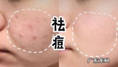 季节性长痘痘怎么办 换季长痘