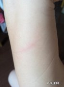 被家猫抓伤出血要打狂犬疫苗吗 被家猫抓伤