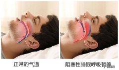 如何有效的治疗改善打鼾症状？