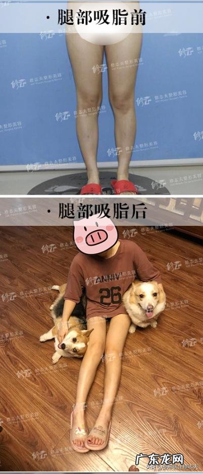 抽脂减肥是一种怎样的体验