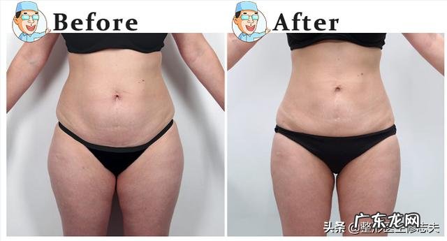 抽脂减肥是一种怎样的体验