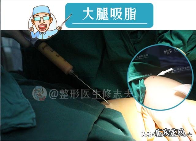 抽脂减肥是一种怎样的体验