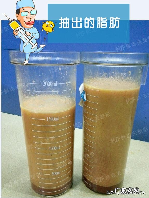 抽脂减肥是一种怎样的体验