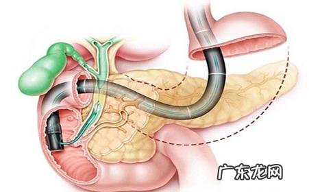 胰腺癌是否有早,中,晚期?