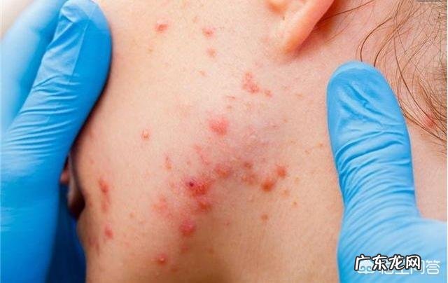 入秋后,哪些表现说明体内毒素多怎样才能促排毒