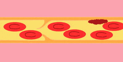 脑梗都是拖出来的?医生提醒:7个信号要重视,5件小事要常做!