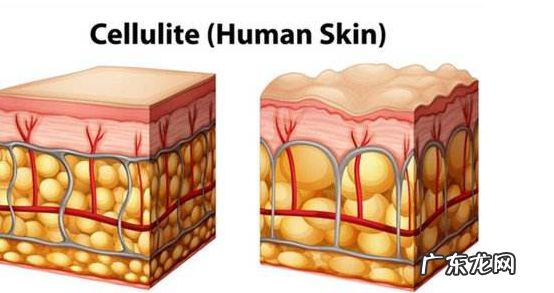 刮痧减肥有用吗 刮痧减肥要注意方法