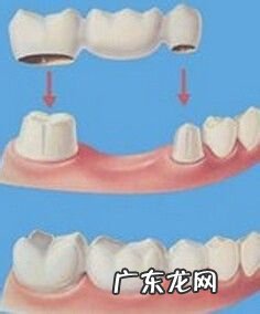 烤瓷牙能用多久