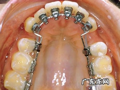 牙齿矫正最快的方法