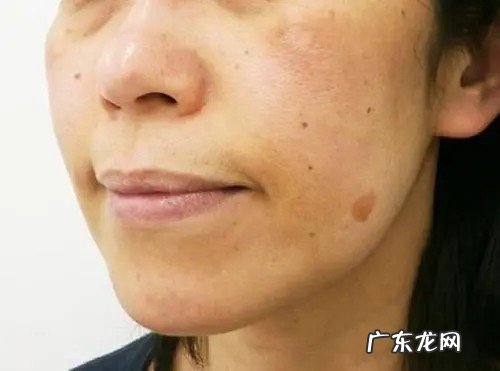 吃什么可以排毒去色斑 吃什么去色斑