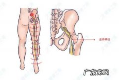 坐骨神经痛的缓解及治疗方法